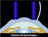 techn persbylasik