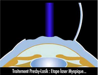 tchn presbylasik