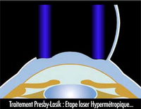 techn persbylasik