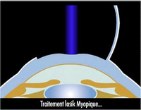 techn persbylasik