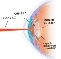 techn persbylasik
