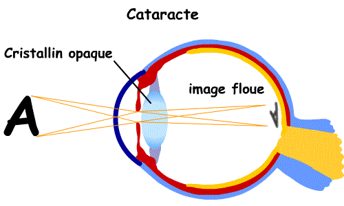 cataracte
