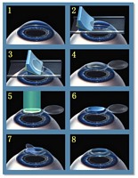 étapes lasik