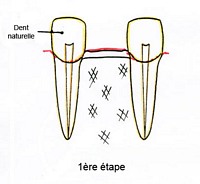 1etape