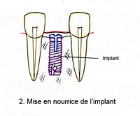 1etape