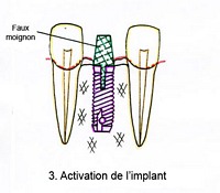 1etape