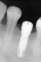 implant